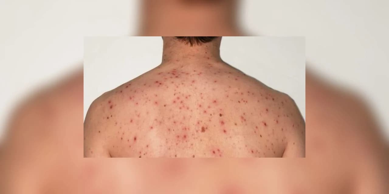 Sarampo tem dez novos casos no Paraná