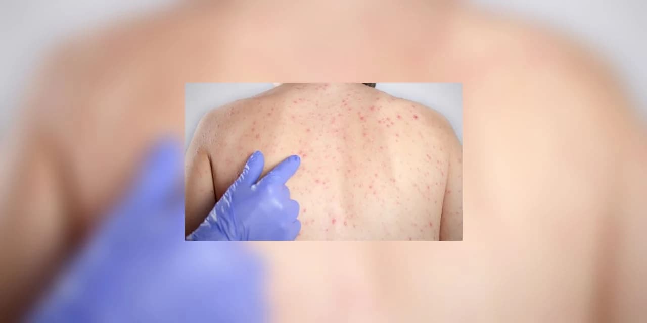 Saúde confirma 50 novos casos de sarampo no Paraná